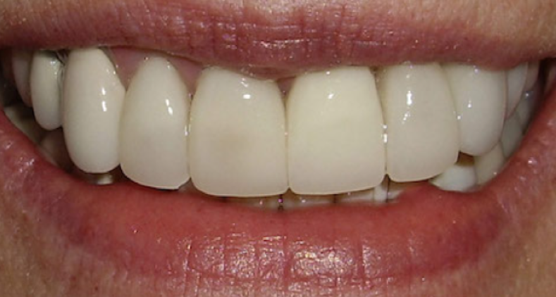 Teeth whitening after treatment